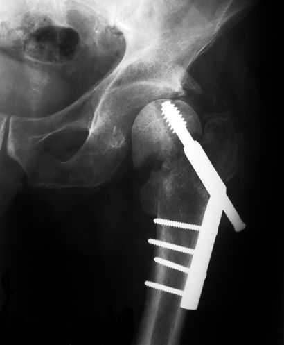 ASTM F543-13 testing medical bone screws